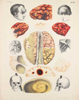 [Брунс В. Хирургический атлас. Наглядное описание хирургических заболеваний, инструментов, повязок и операций, необходимых для их лечения, составленное доктором Виктором Брунсом. Первый отдел. Мозг и оболочки]. Tübingen, 1854.